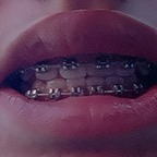bracesfetish onlyfans leaked picture 1